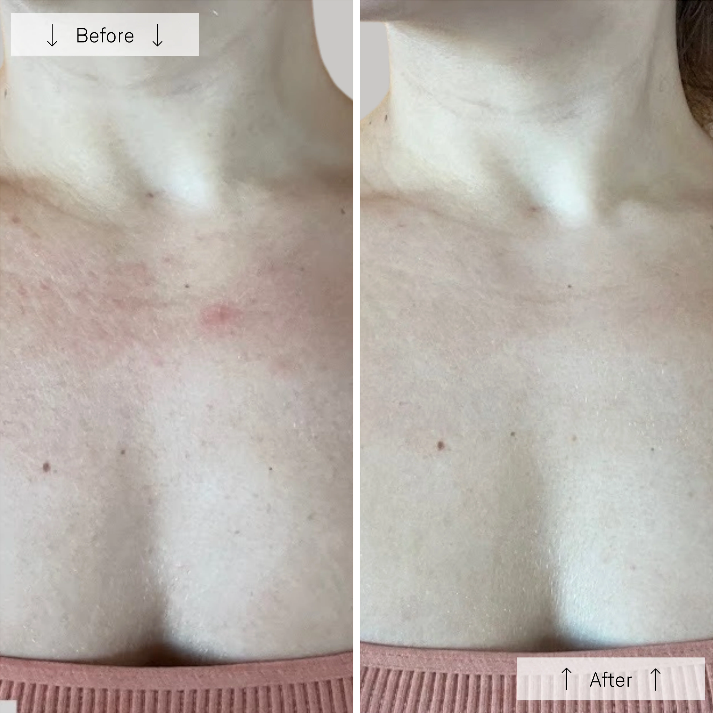 Before and after images of the wedoskin Omnilux Contour Neck & Décolleté anti-aging device showcasing skin improvement.