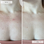Before and after images of the wedoskin Omnilux Contour Neck & Décolleté anti-aging device showcasing skin improvement.