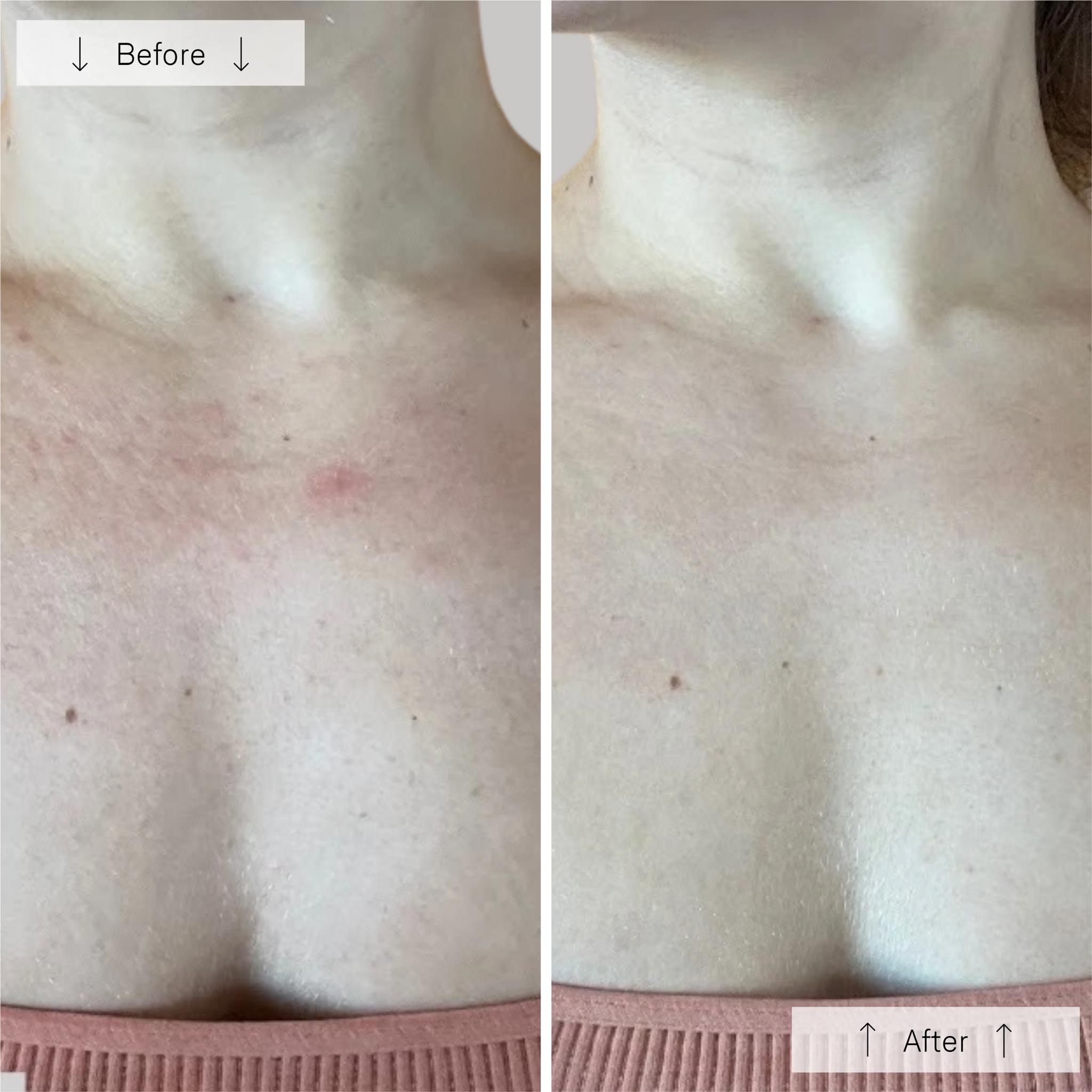 Before and after images of the wedoskin Omnilux Contour Neck & Décolleté anti-aging device showcasing skin improvement.