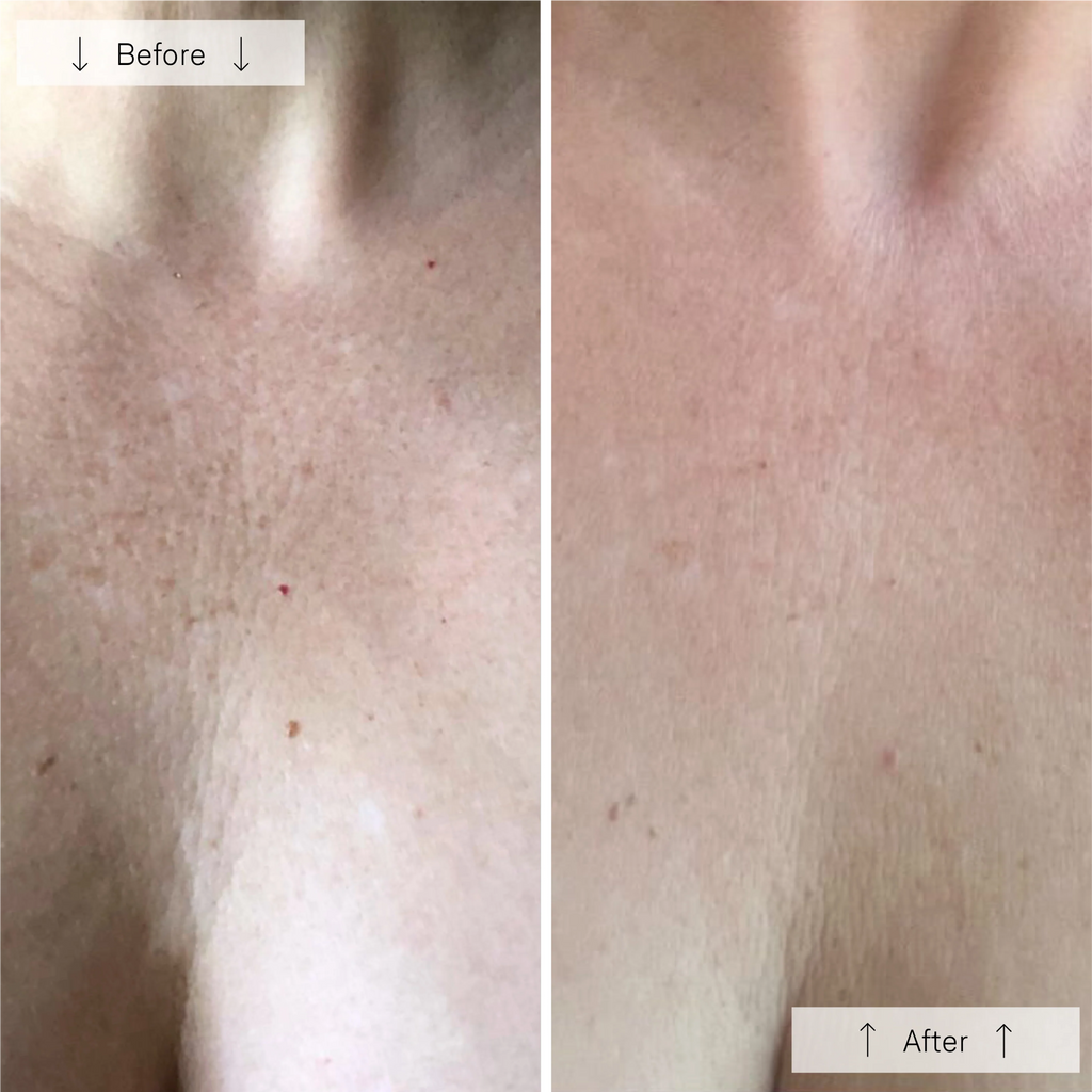 Before and after images of the wedoskin Omnilux Contour Neck & Décolleté anti-aging device showing skin improvement.