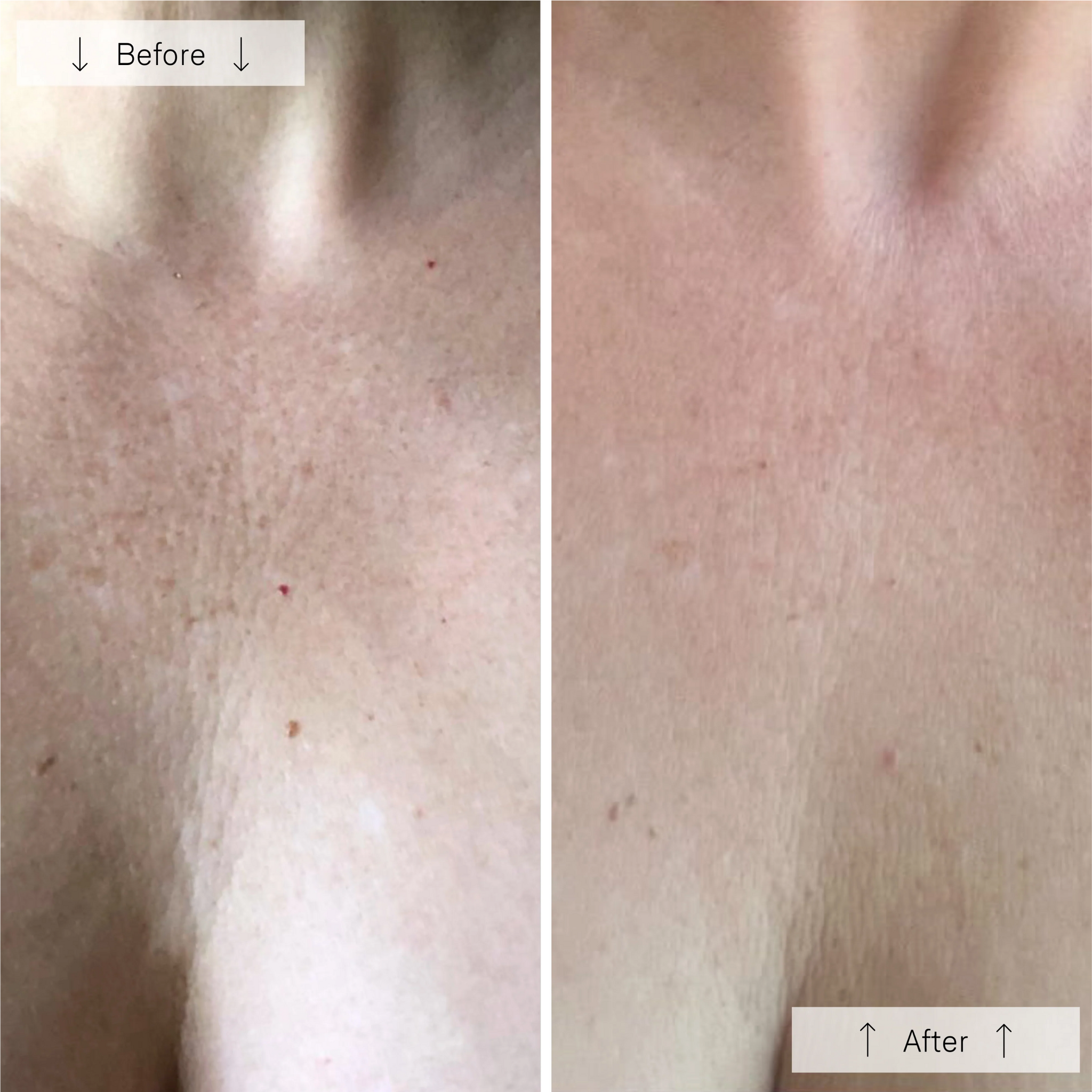 Before and after images of the wedoskin Omnilux Contour Neck & Décolleté anti-aging device showing skin improvement.