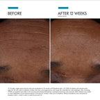 SkinCeuticals P-TIOX Needle-Free Anti-Wrinkle Serum bottle with before and after skin improvement images, showcasing its anti-aging effects.