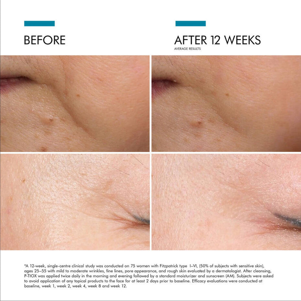SkinCeuticals P-TIOX needle-free anti-wrinkle serum from wedoskin, showing before and after skin improvement images.