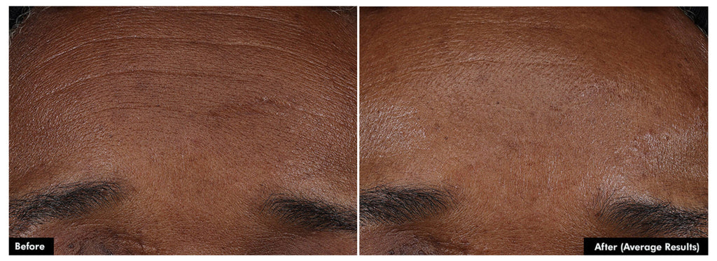 Side-by-side before and after images showing SkinCeuticals P-TIOX needle-free anti-wrinkle serum reducing fine lines on facial skin.
