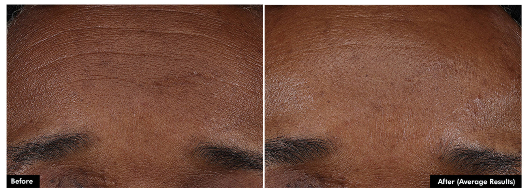 Side-by-side before and after images showing SkinCeuticals P-TIOX needle-free anti-wrinkle serum reducing fine lines on facial skin.