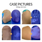 UVA Lamp Skin Analyzer