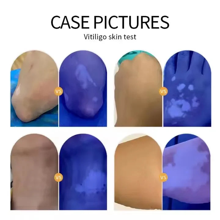 UVA Lamp Skin Analyzer