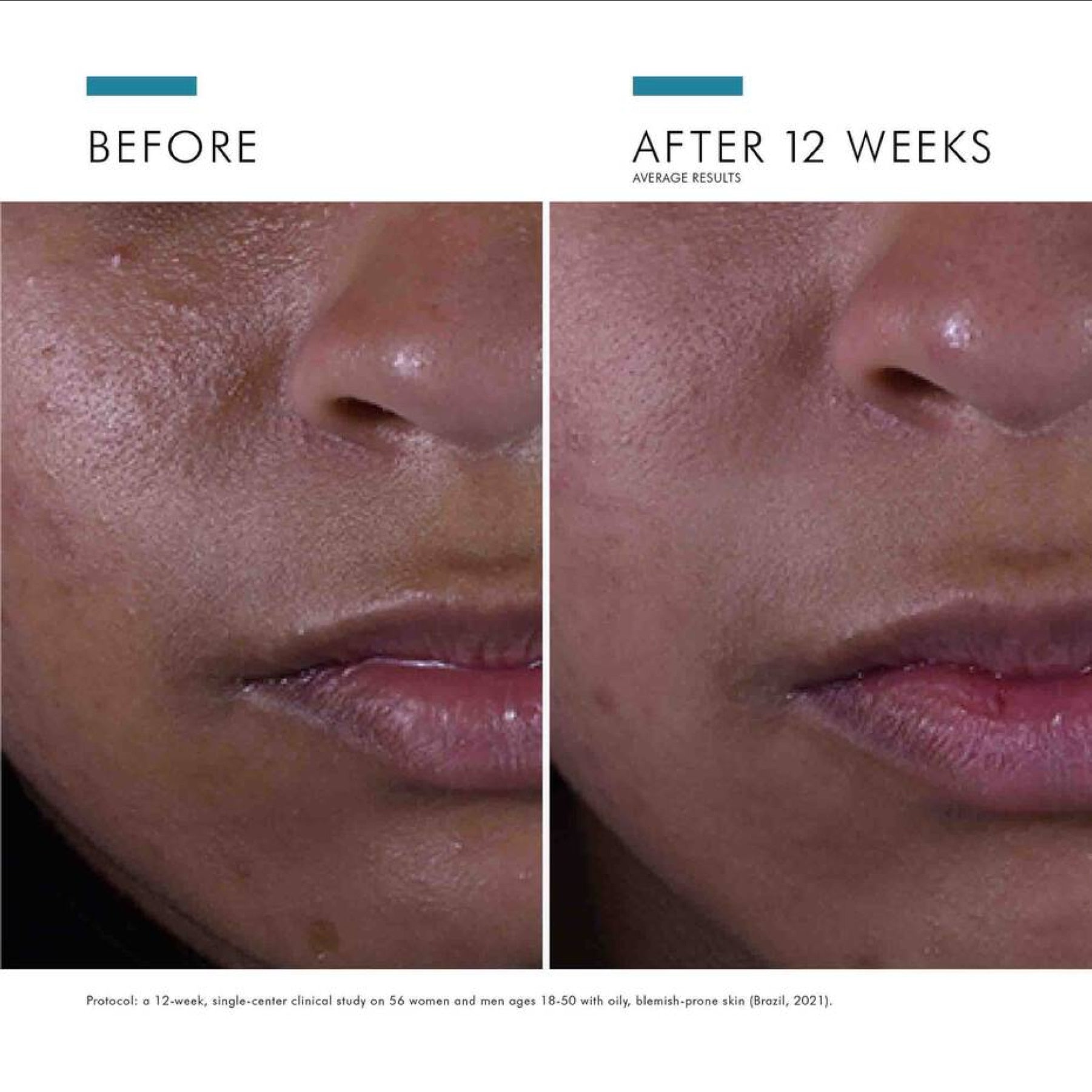 Before and after images of wedoskin SkinCeuticals Silymarin CF serum showing improved skin clarity and brightness.