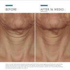 Before and after images showing SkinCeuticals Tripeptide-R Neck Repair on neck skin, highlighting skin improvement and rejuvenation.