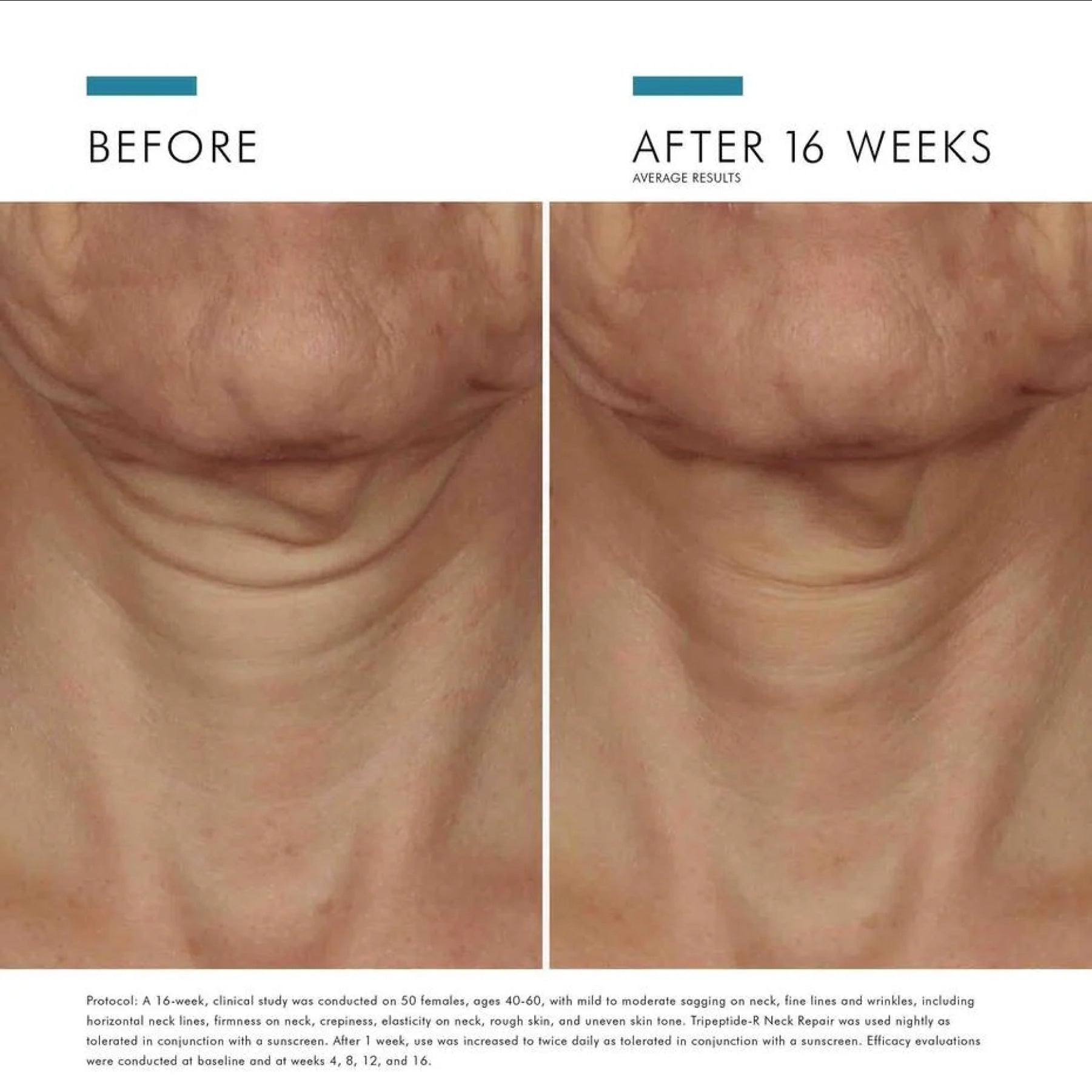 Before and after images showing SkinCeuticals Tripeptide-R Neck Repair on neck skin, highlighting skin improvement and rejuvenation.
