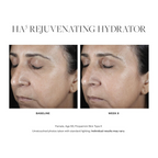 Before and after images of wedoskin SkinMedica HA5 Rejuvenating Hydrator showing improved skin hydration and smoothness.